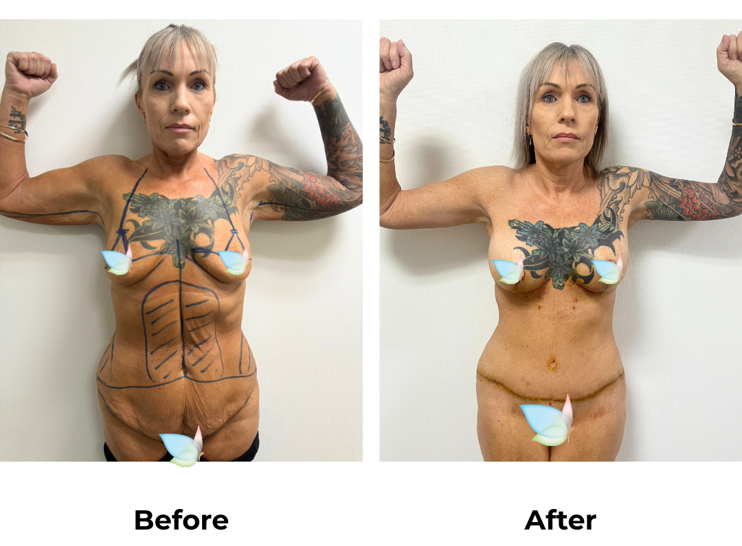 Kym had Mons lift + lipo 2 areas on upper abs & Love handles +ALBABL (325,350 M+) with Dr. Ring (1)