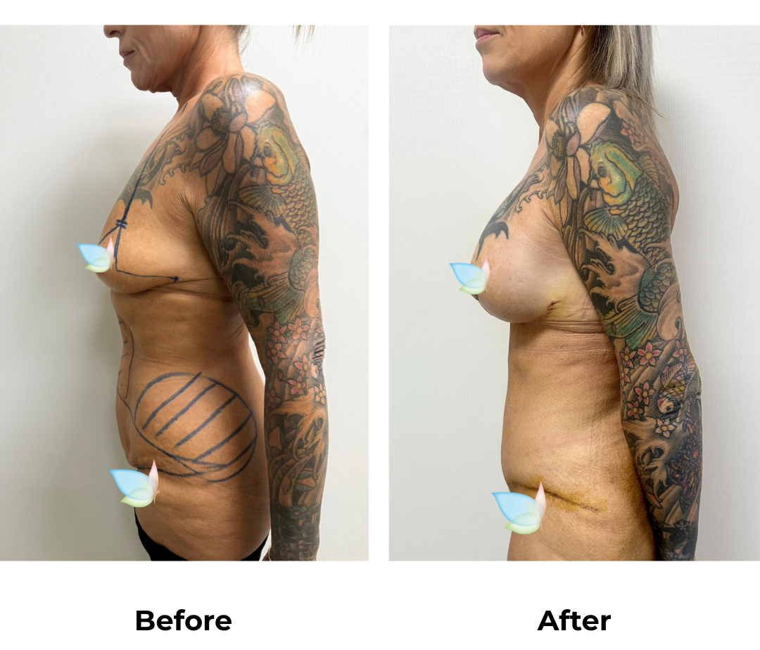 Kym had Mons lift + lipo 2 areas on upper abs & Love handles +ALBABL (325,350 M+) with Dr. Ring