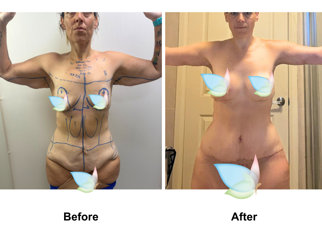 Lara had BABL (300 HP) + AL + ExTT + Mons lift + Lipo4 areas with Dr. Kasemsak