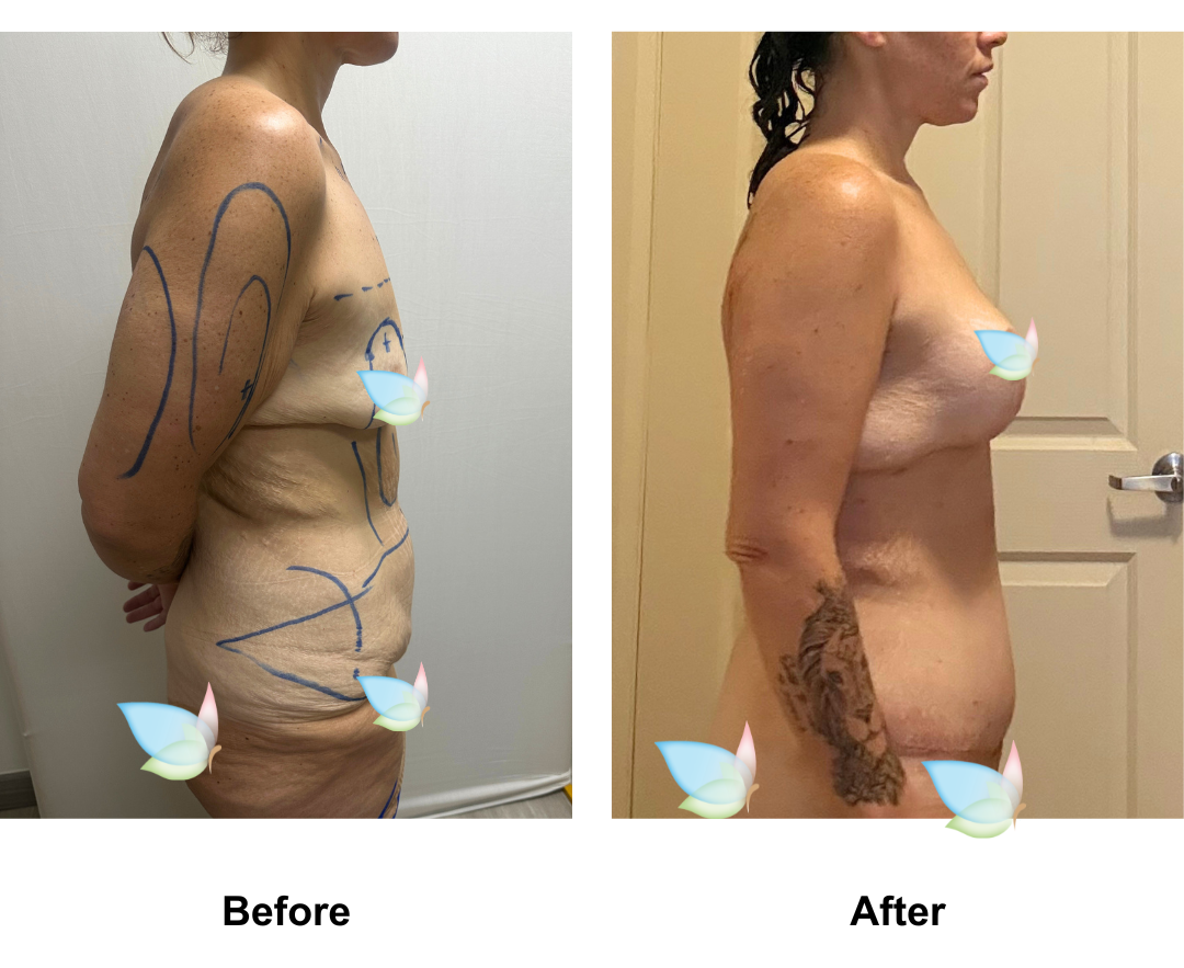 Lara had BABL (300 HP) + AL + ExTT + Mons lift + Lipo_4 areas with Dr. Kasemsak