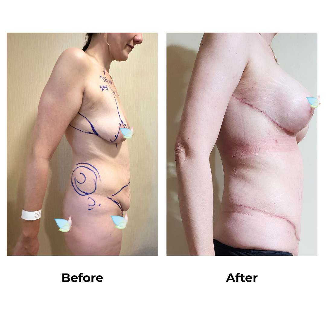 Larisa had BABL + AL +  SL + ExTT + Lipo on love handles + ML with Dr. Angkana