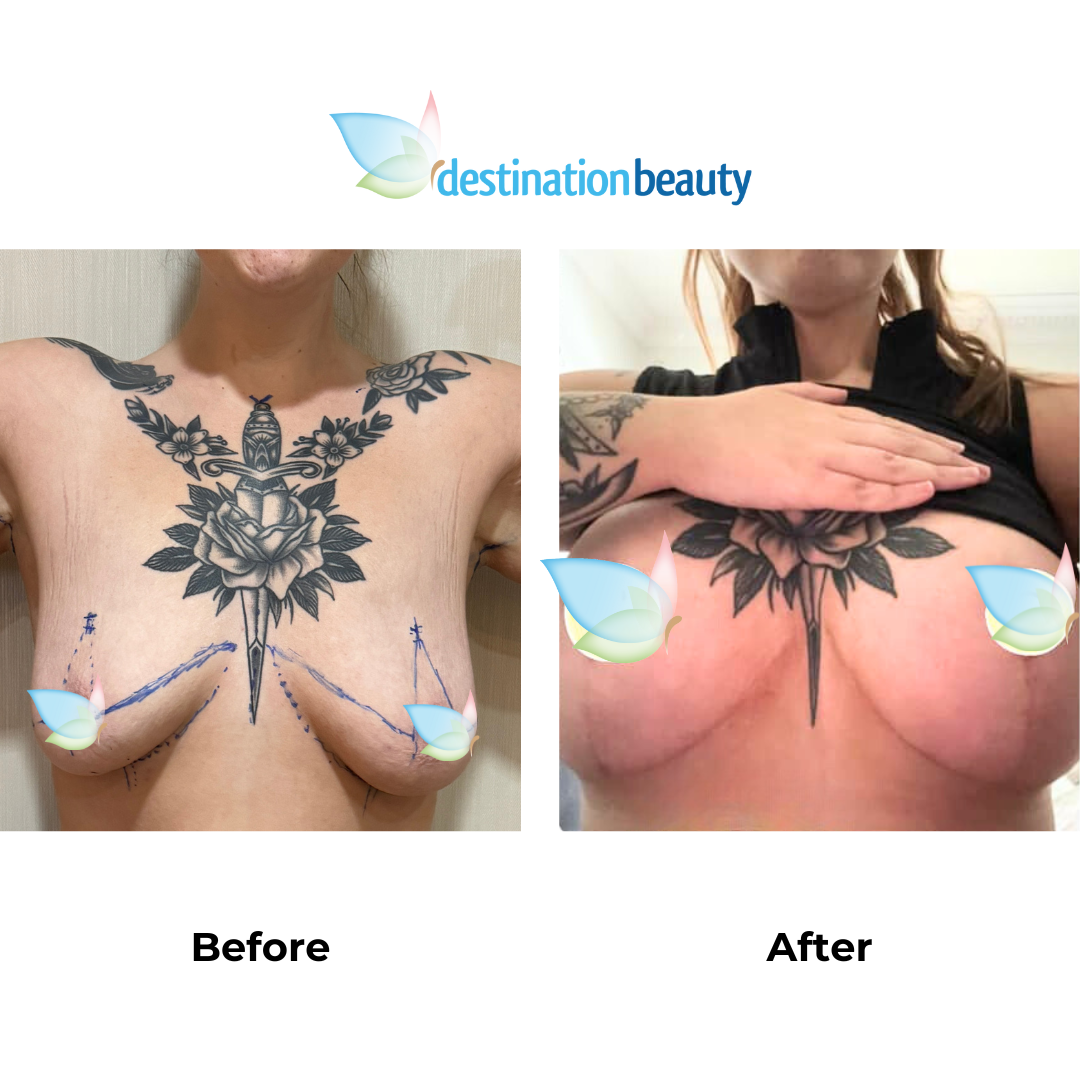 Launa had breast augmentation with lift in Thailand