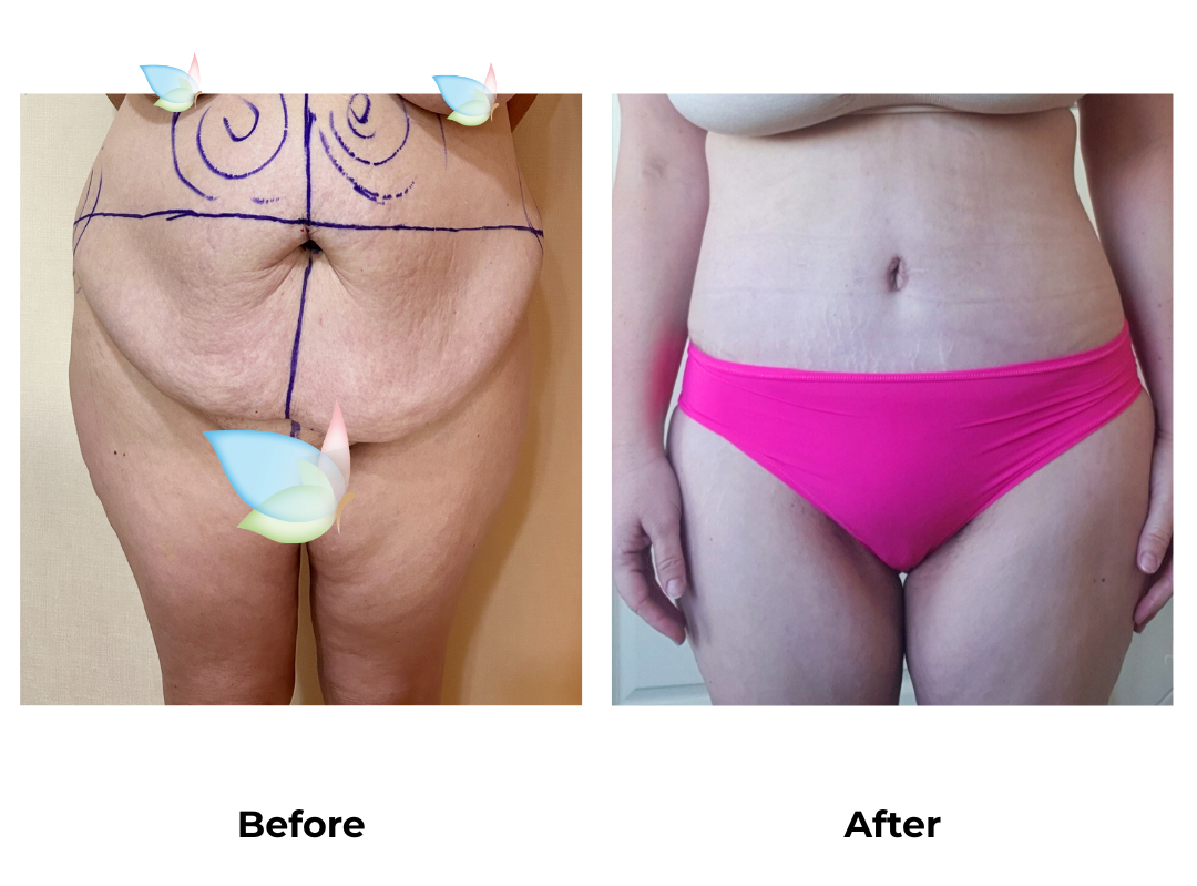 Lauren had Ex TT, Lipo with Dr. Angkana 1