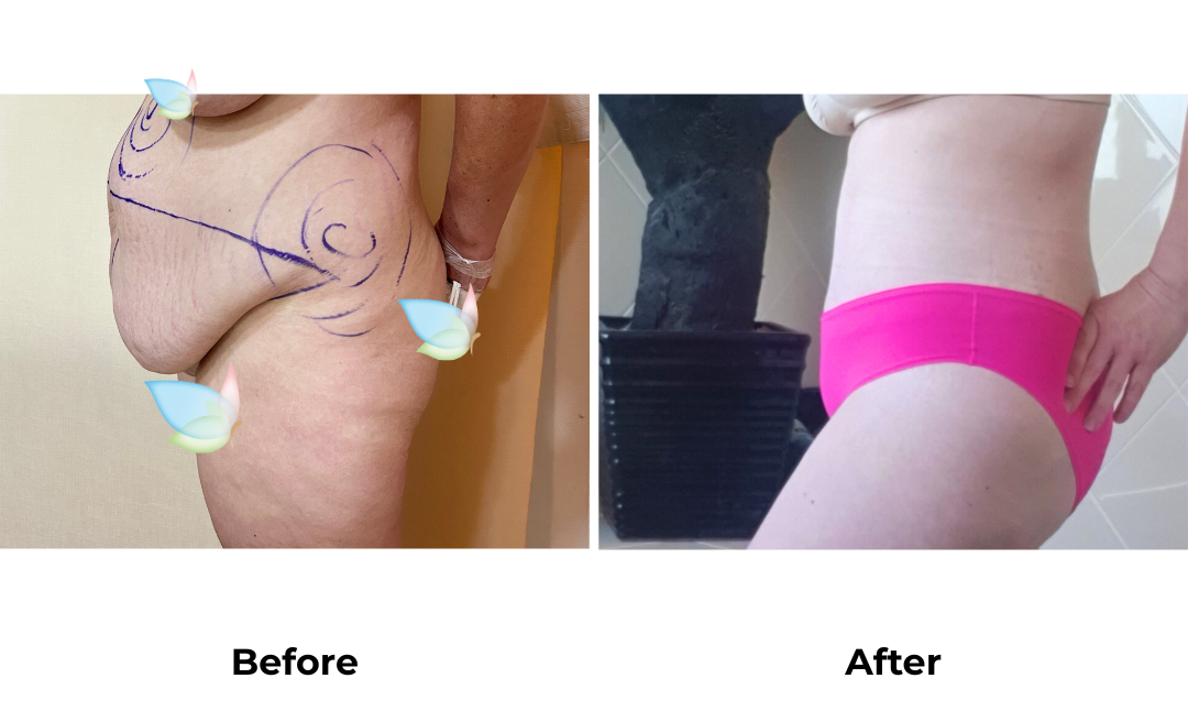 Lauren had Ex TT, Lipo with Dr. Angkana 2