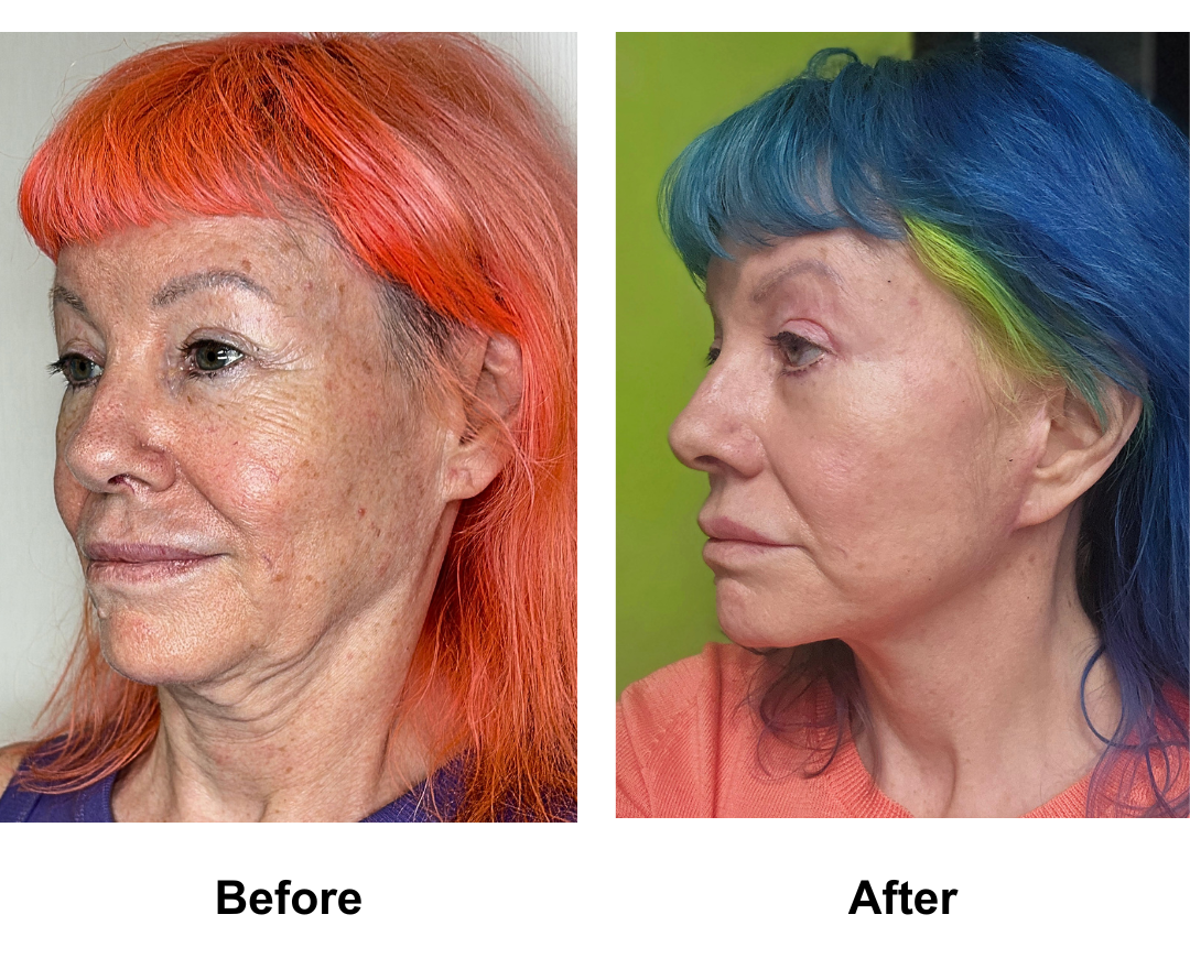 Leanne, 61 had MFNL + Plastymaplasty + LB with Dr. Ring  (1)