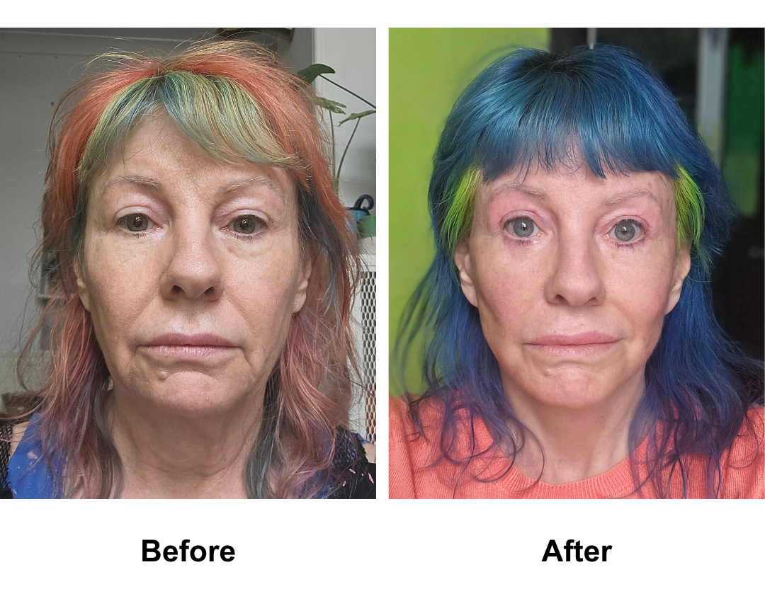 Leanne, 61 had MFNL + Plastymaplasty + LB with Dr. Ring  (3)
