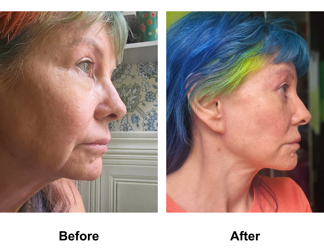 Leanne, 61 had MFNL + Plastymaplasty + LB with Dr. Ring  (4)