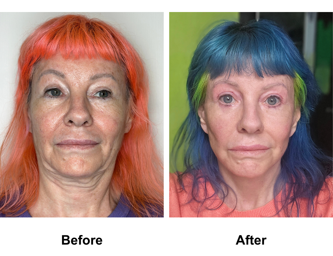 Leanne, 61 had MFNL + Plastymaplasty + LB with Dr. Ring