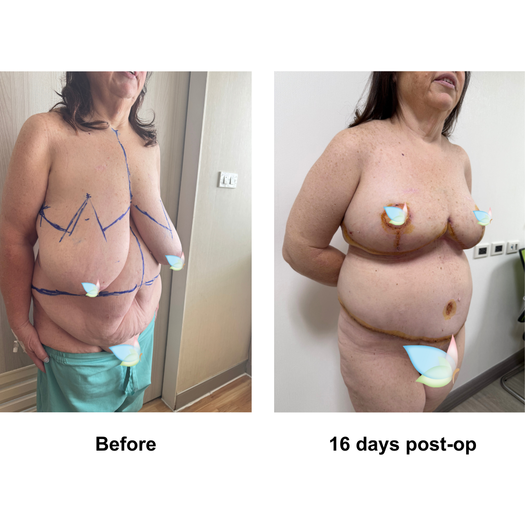 Letitia had BR + AL + side lift  + ExTT + lipo _2 + Mons lift with Dr. Weerachai (2)
