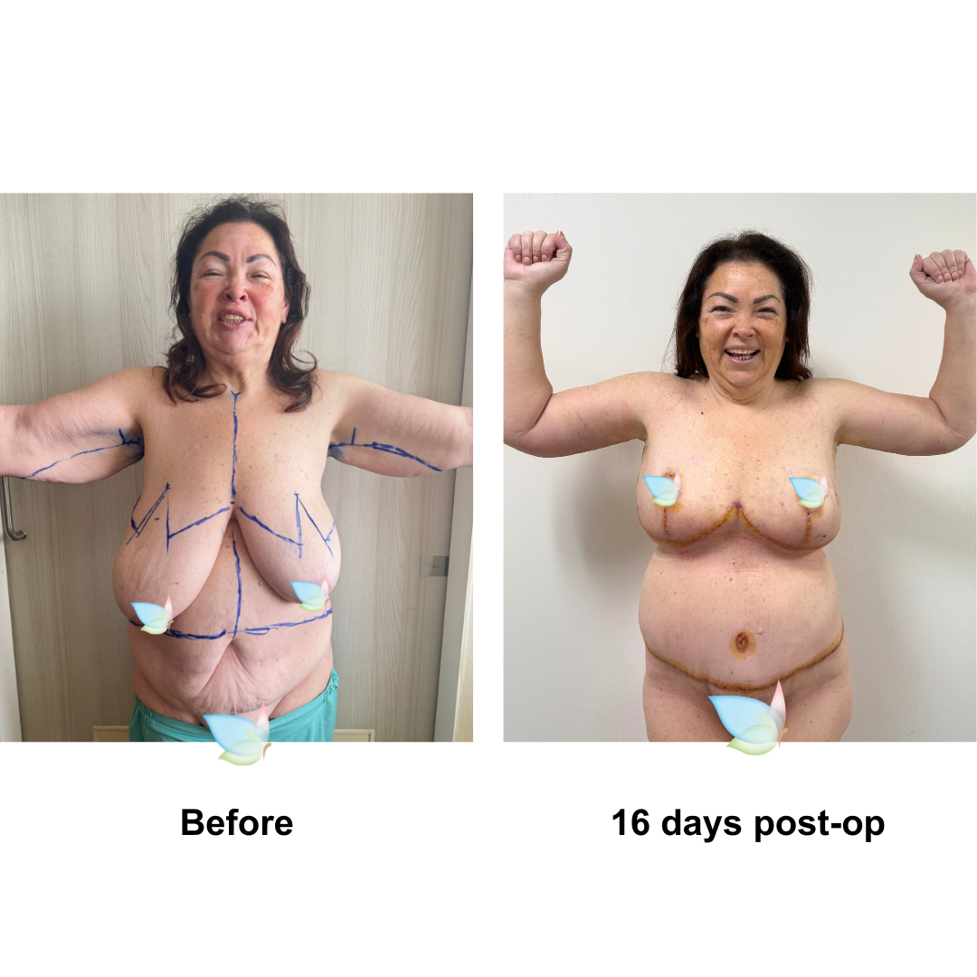 Letitia had BR + AL + side lift  + ExTT + lipo _2 + Mons lift with Dr. Weerachai