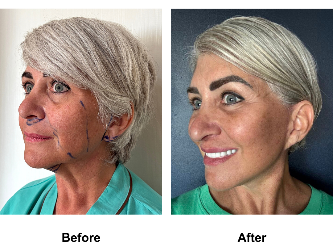 Lilys full face transformation (1)