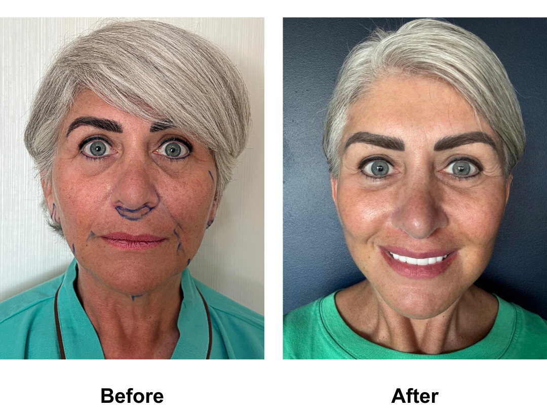 Lilys full face transformation