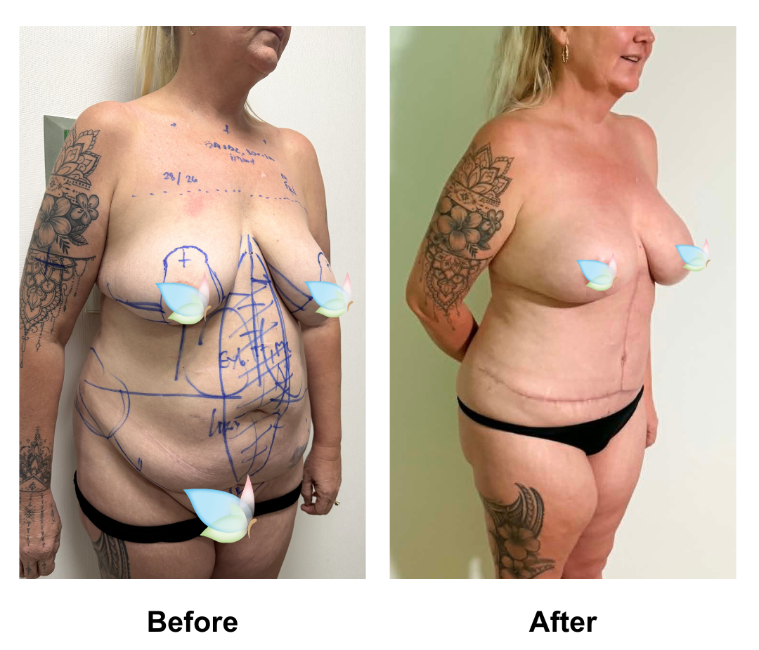 Lisa had BABL + FDL TT+ Lipo2 + Mons lift with Dr. Kasemsak (1)