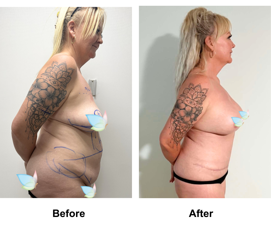 Lisa had BABL + FDL TT+ Lipo2 + Mons lift with Dr. Kasemsak