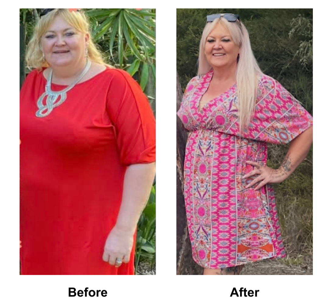 Lisa had gastric sleeve