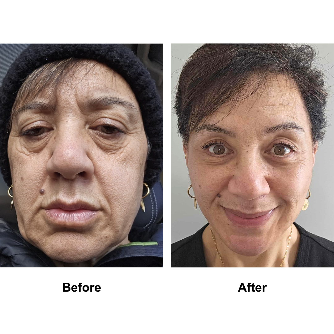 Liz had MFNL + LB with Dr. Jatuporn (1)