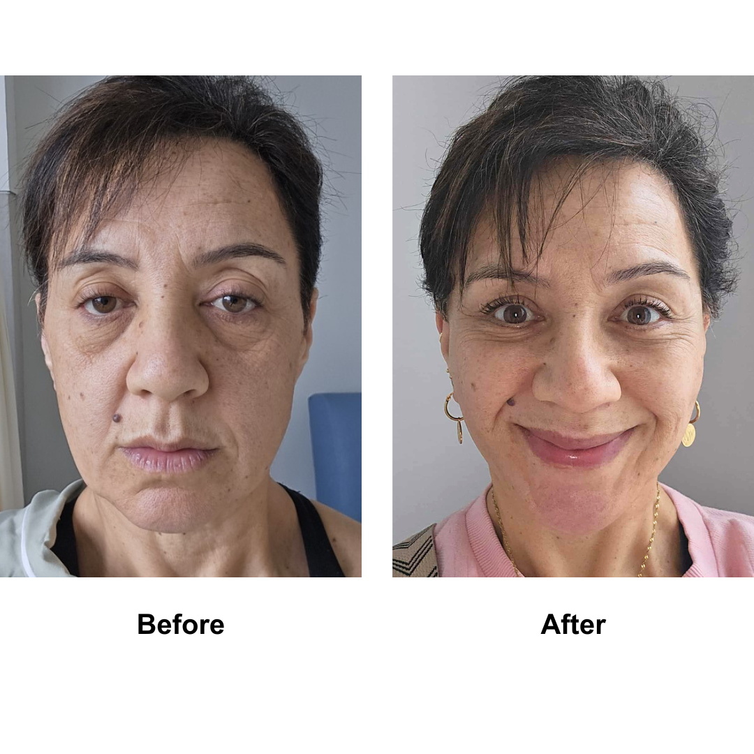 Liz had MFNL + LB with Dr. Jatuporn (2)