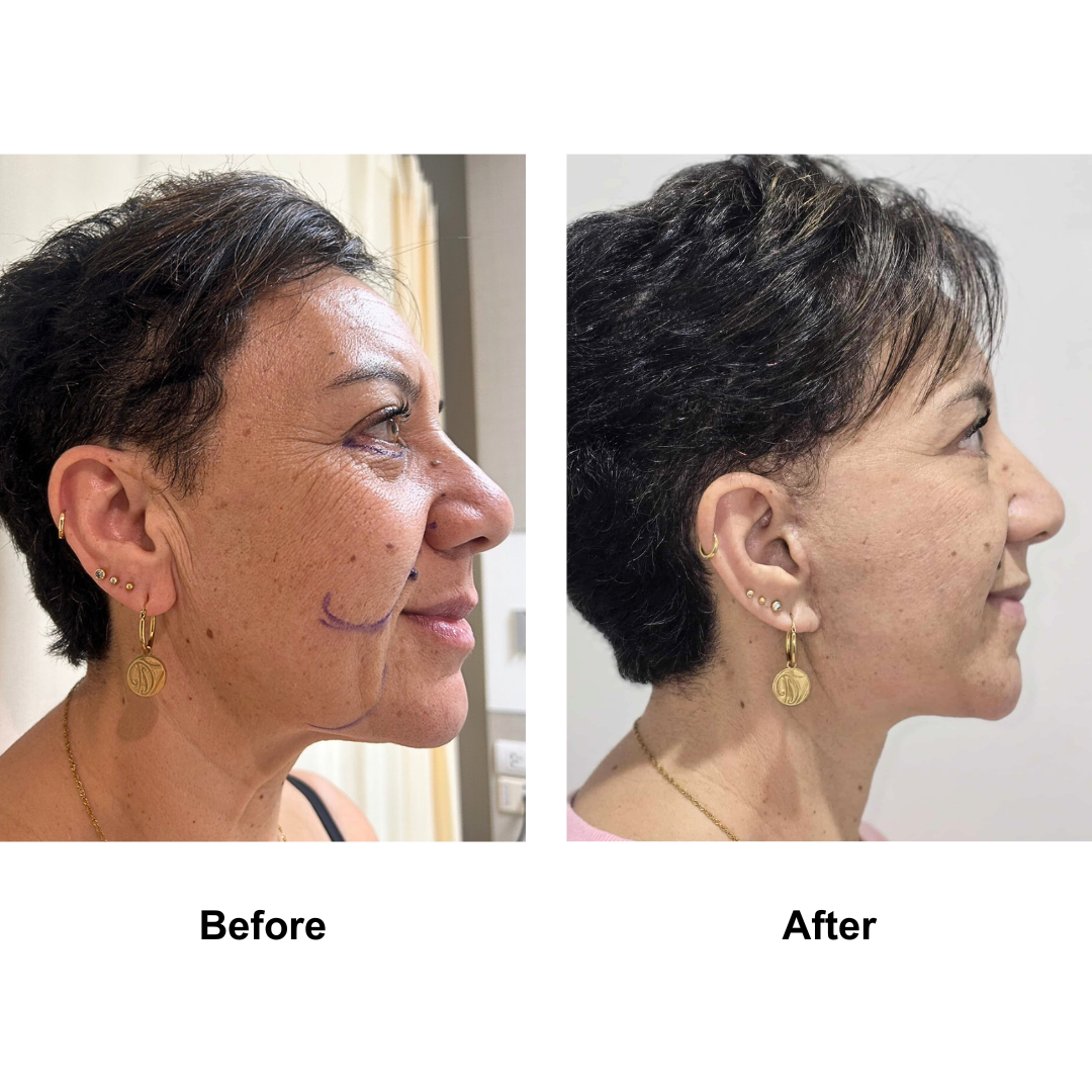 Liz had MFNL + LB with Dr. Jatuporn (3)