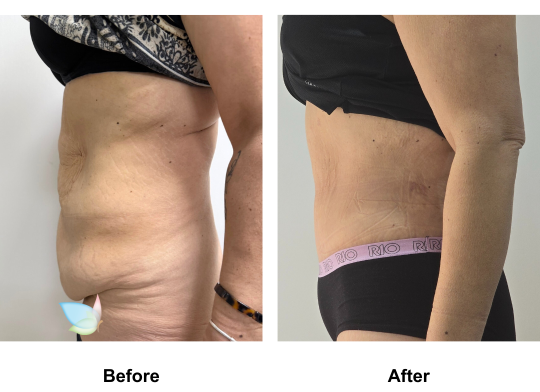 Liz had Semi circum TT+Mon lift + Lipo2 on upper abdomen and waist Dr. Jatuporn (1)