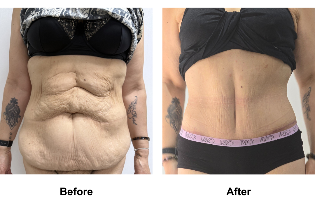 Liz had Semi circum TT+Mon lift + Lipo2 on upper abdomen and waist Dr. Jatuporn (2)