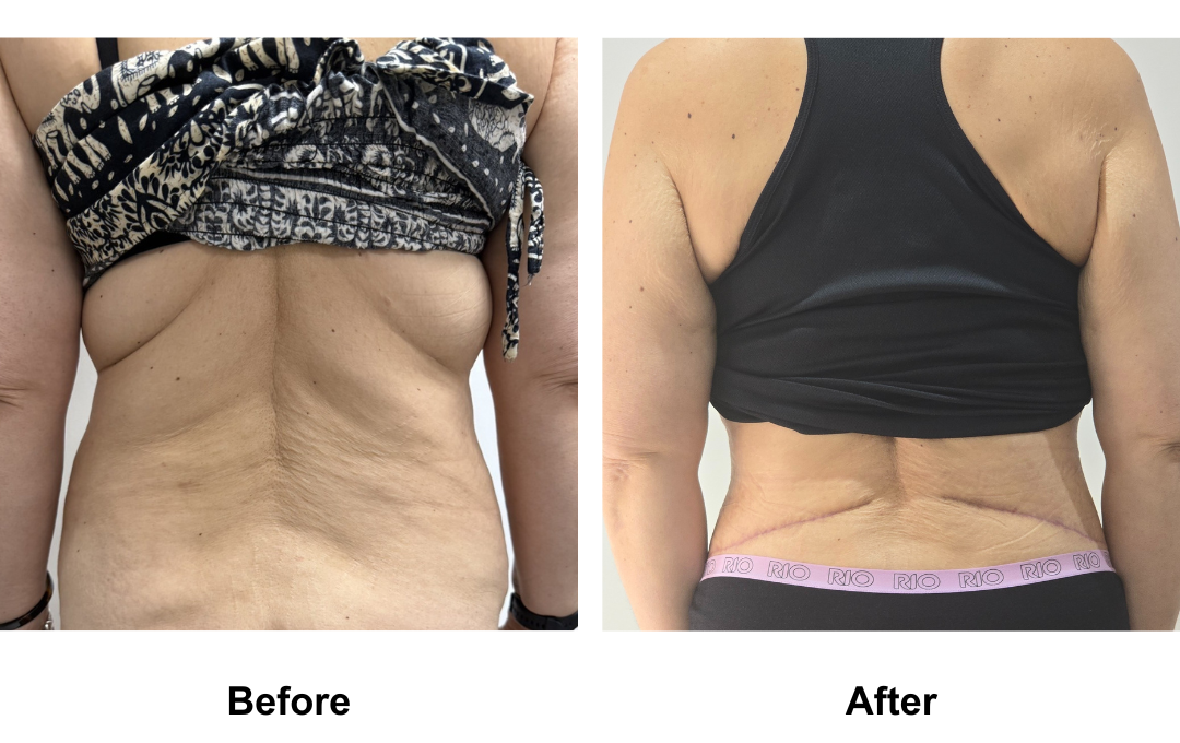 Liz had Semi circum TT+Mon lift + Lipo2 on upper abdomen and waist Dr. Jatuporn