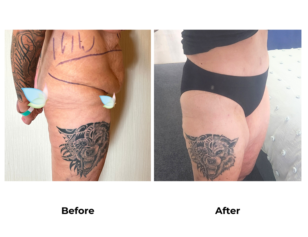 Loretta had Ex TT, Lipo2 with Dr. Ring  (1)