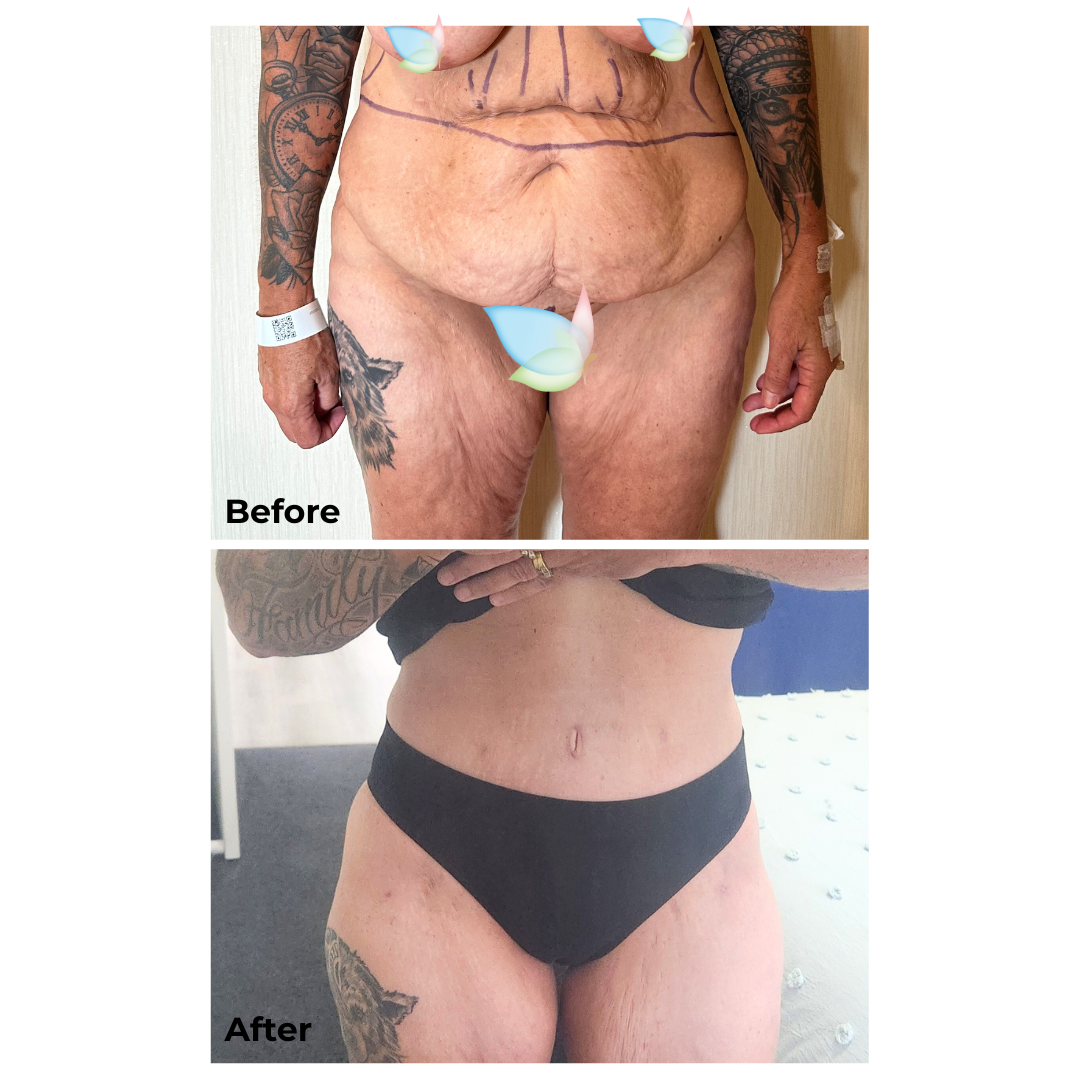 Loretta had Ex TT, Lipo2 with Dr. Ring