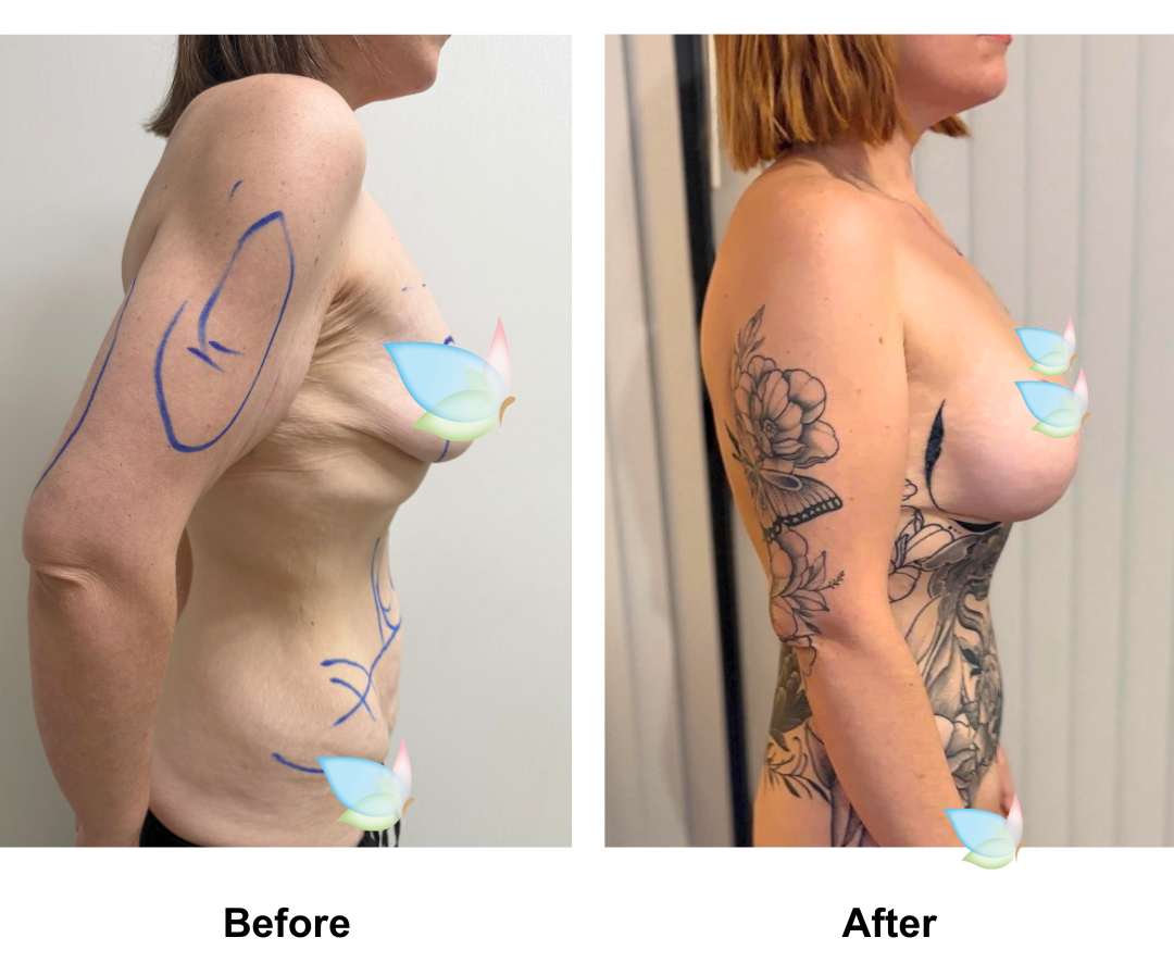 Louise had BABL + AL + ExTT + lipo_2 + Mons lift + Chin lift with Dr. Kasemsak after losing 90 kg (2)