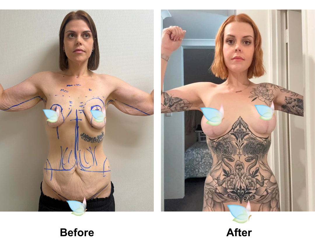 Louise had BABL + AL + ExTT + lipo_2 + Mons lift + Chin lift with Dr. Kasemsak after losing 90 kg