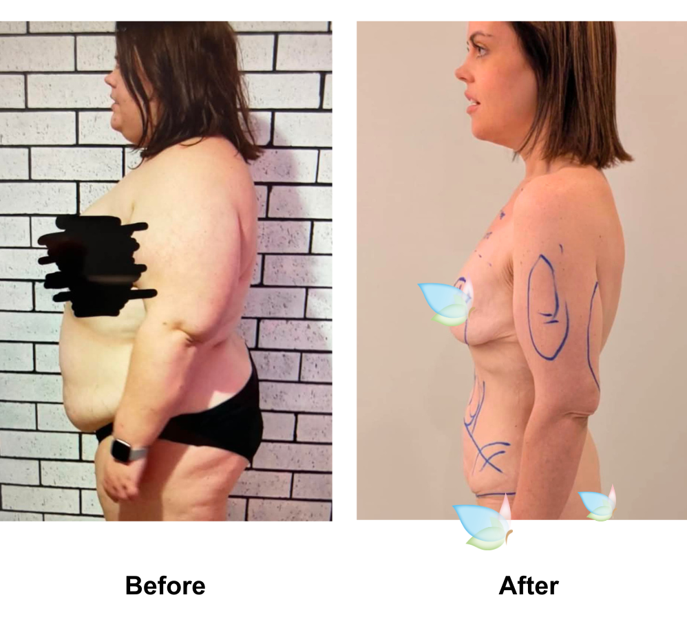 Louise lost 90 kg after gastric sleeve (2)