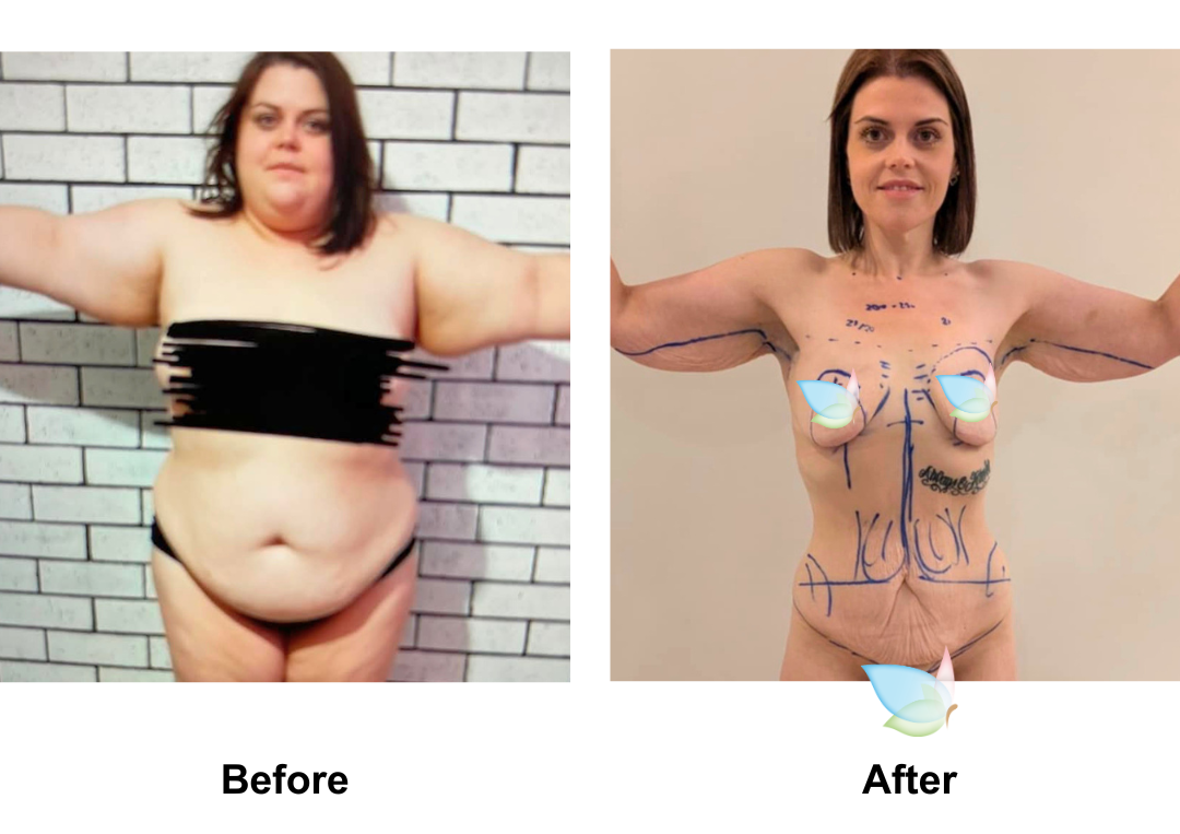 Louise lost 90 kg after gastric sleeve
