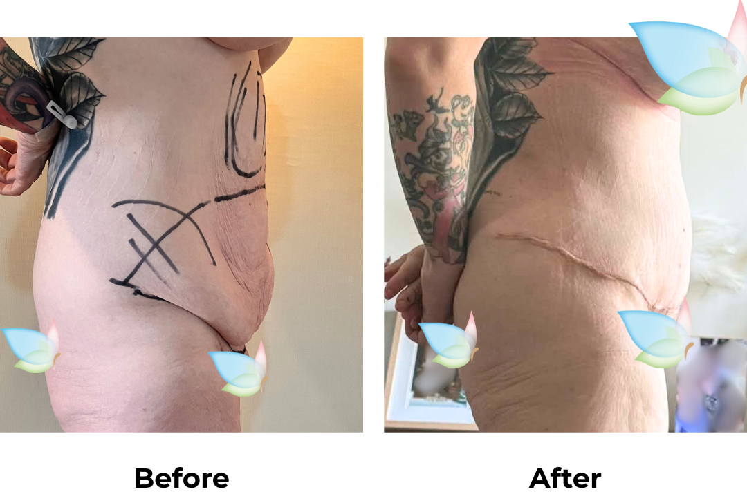 Lydia had ExTT + Vaser liposuction 2 areas (upper abs, love handle) + Mons lift with Dr. Kasemsak (1)