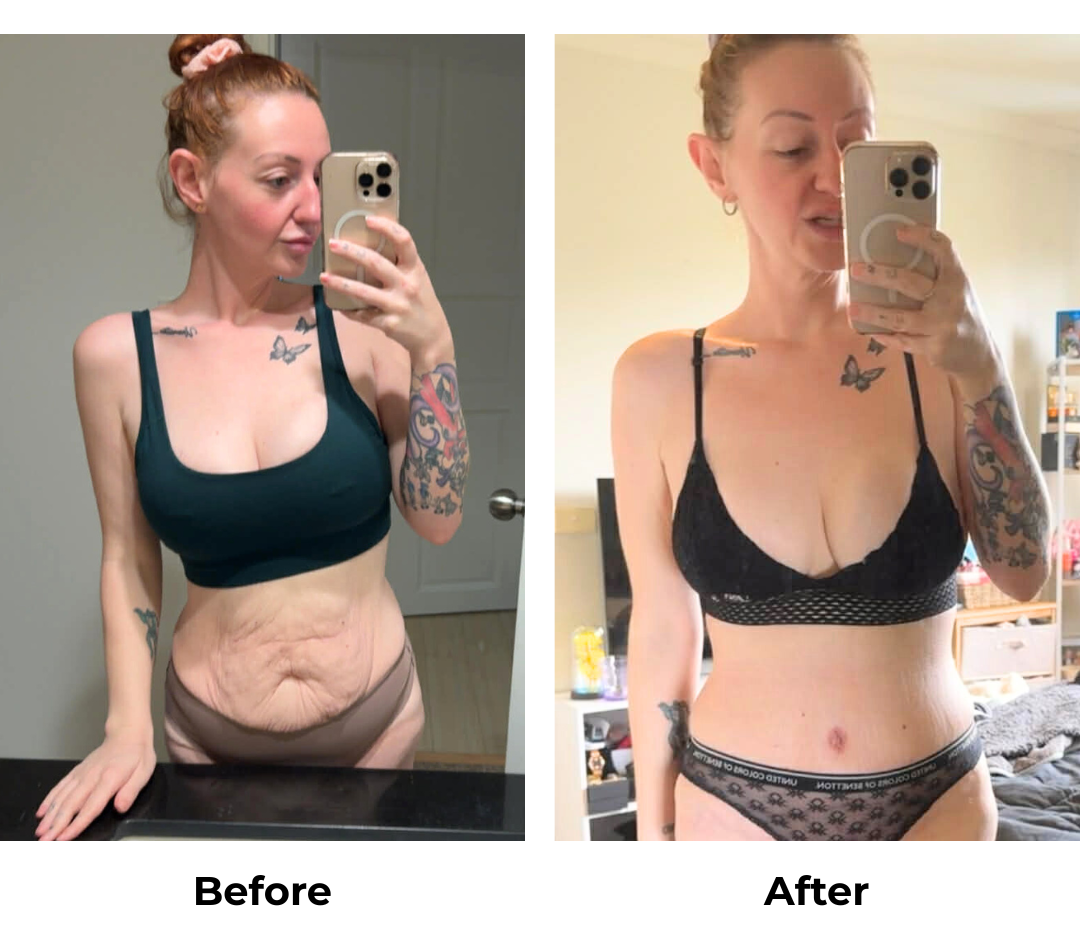 Lydia had ExTT + Vaser liposuction 2 areas (upper abs, love handle) + Mons lift with Dr. Kasemsak (2)