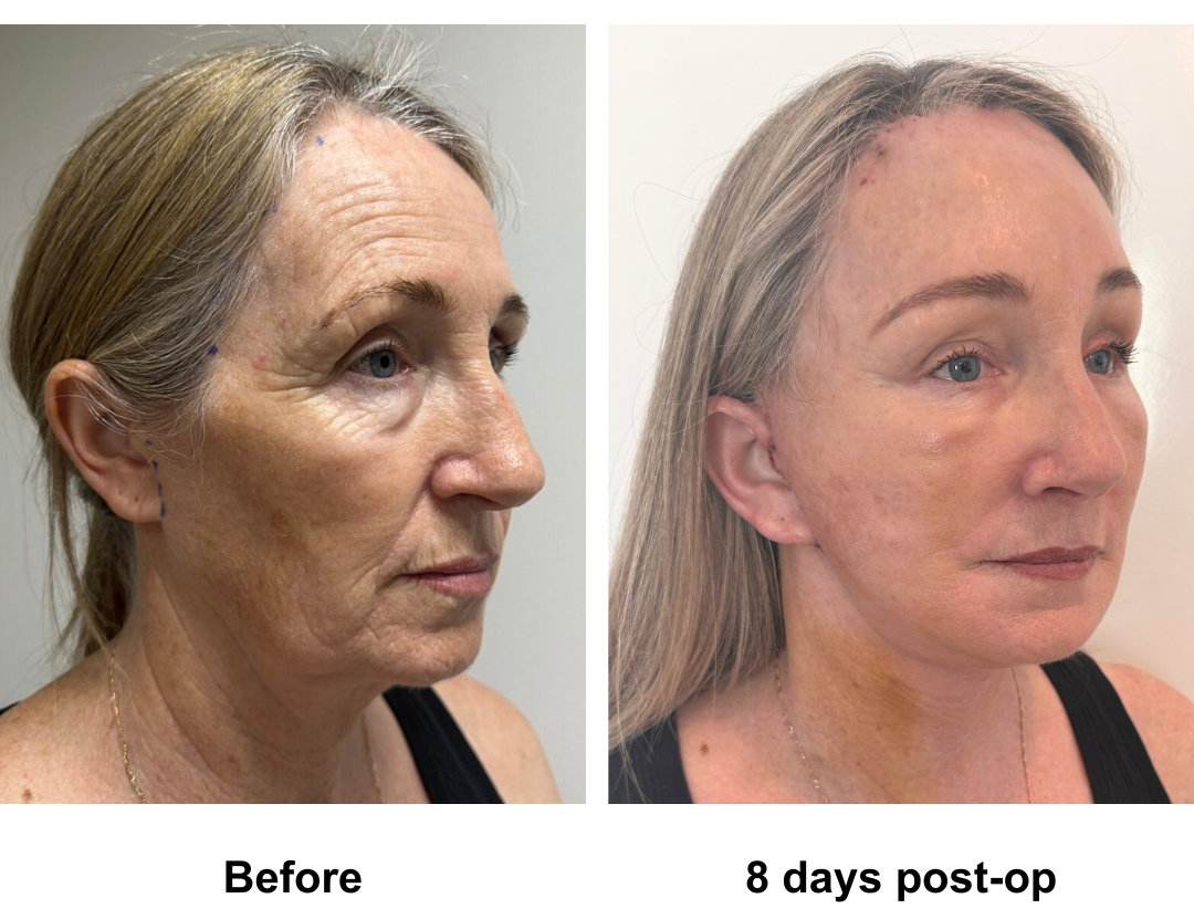 Lynda had FFNL + EBL + Fat transfer to temporal, nasal with Dr. Ring (3)