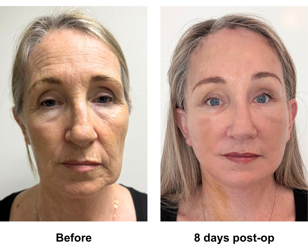 Lynda had FFNL + EBL + Fat transfer to temporal, nasal with Dr. Ring