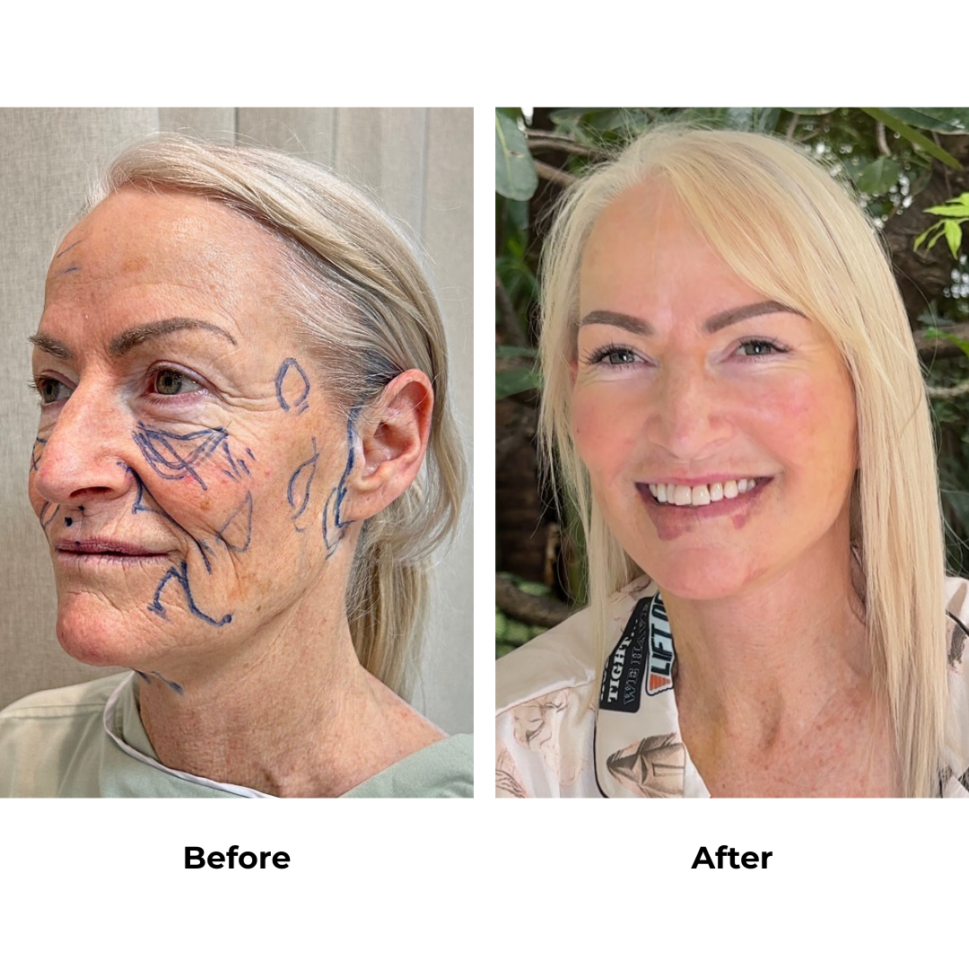 Lynn had FFNL + Fat transfer to face with Dr. NJ (1)