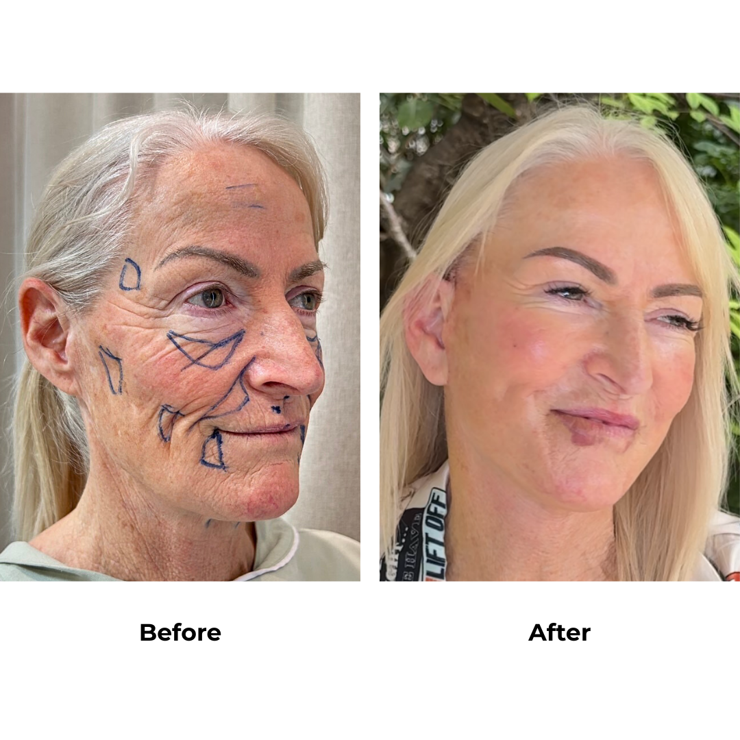 Lynn had FFNL + Fat transfer to face with Dr. NJ (2)