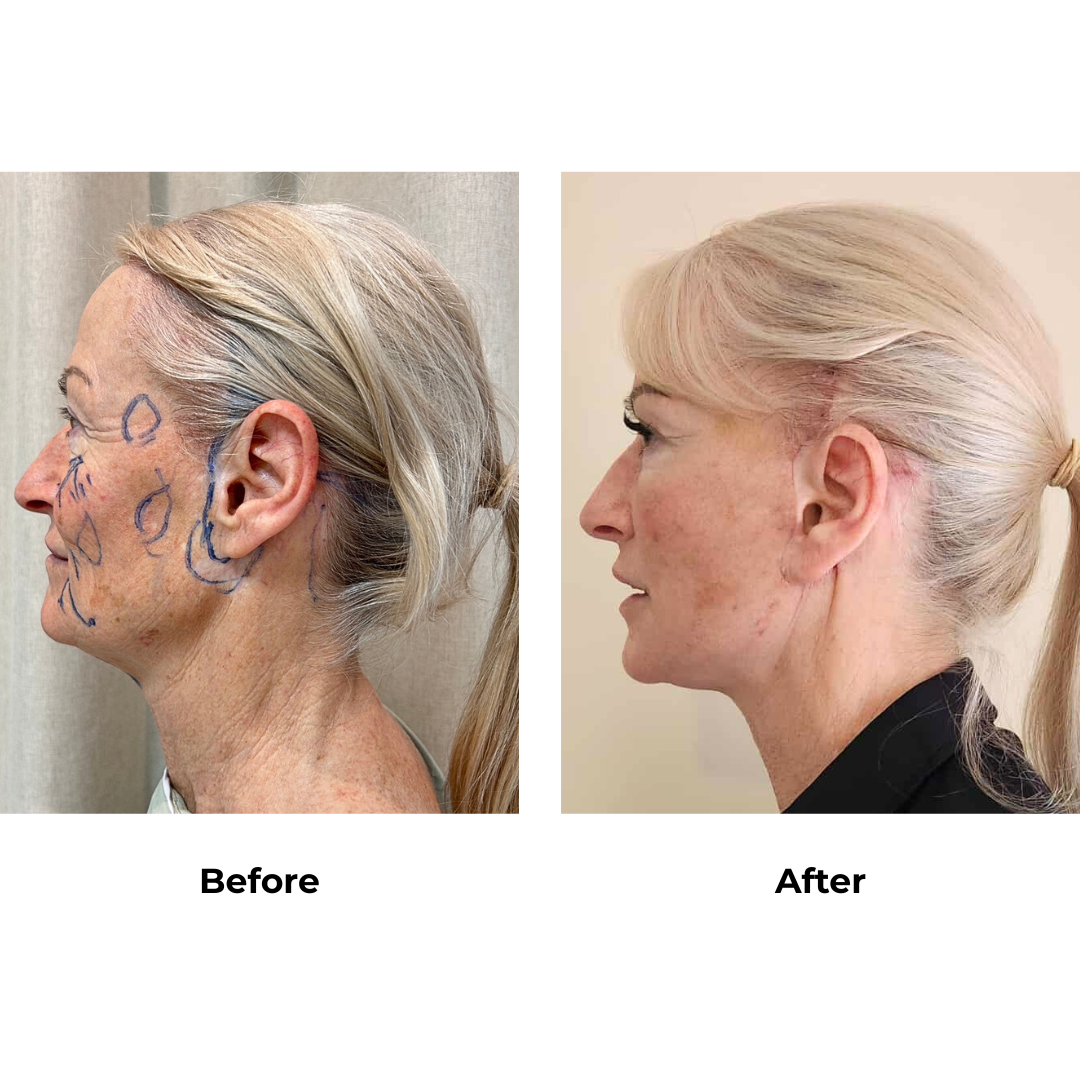 Lynn had FFNL + Fat transfer to face with Dr. NJ (3)