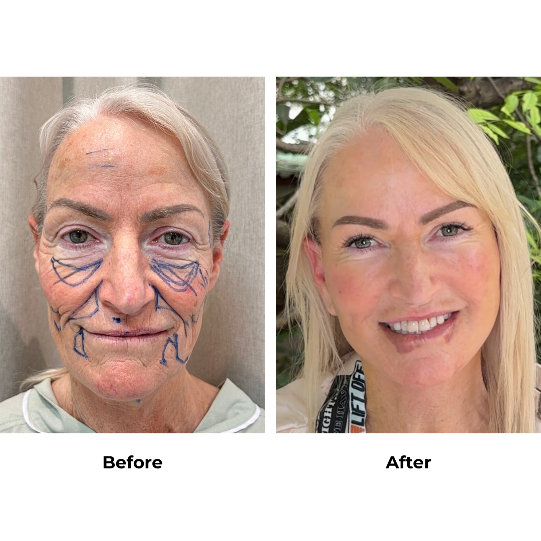 Lynn had FFNL + Fat transfer to face with Dr. NJ