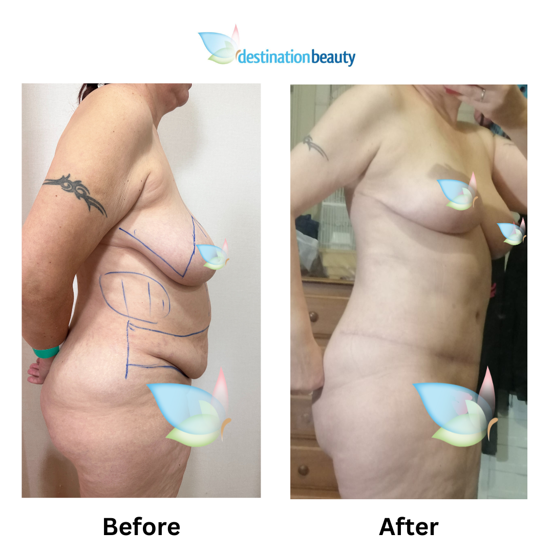 Maggie extended tummy tuck liposuction (2)