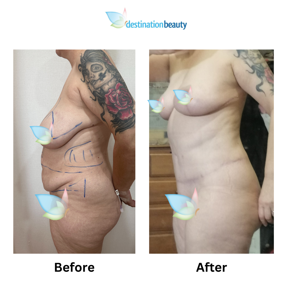 Maggie extended tummy tuck liposuction (3)