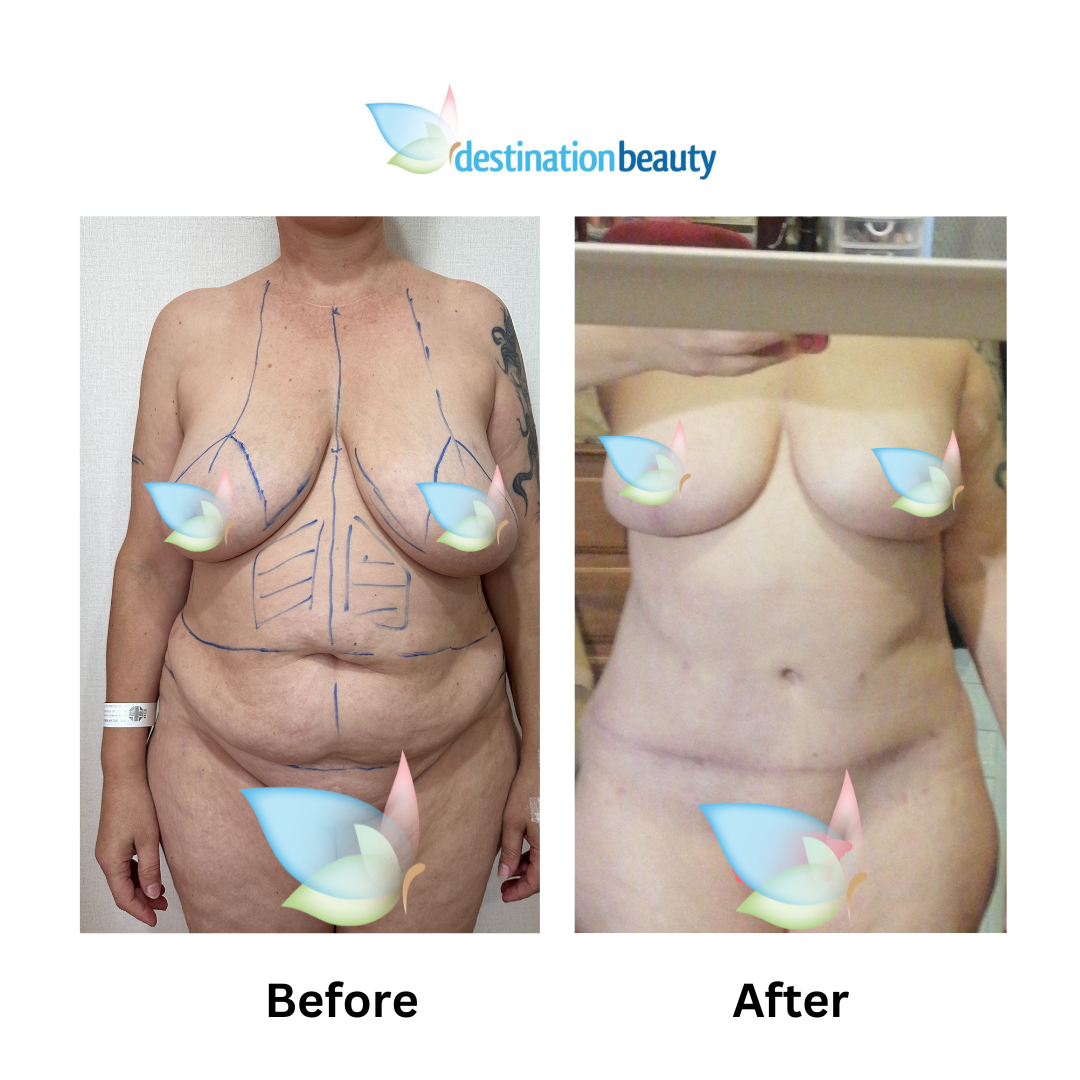 Maggie extended tummy tuck liposuction