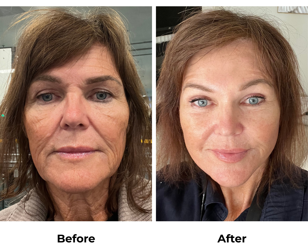 Maree FFNL + Endoscopic Brow Lift + Fat transfer to face with Dr. Ring (1)