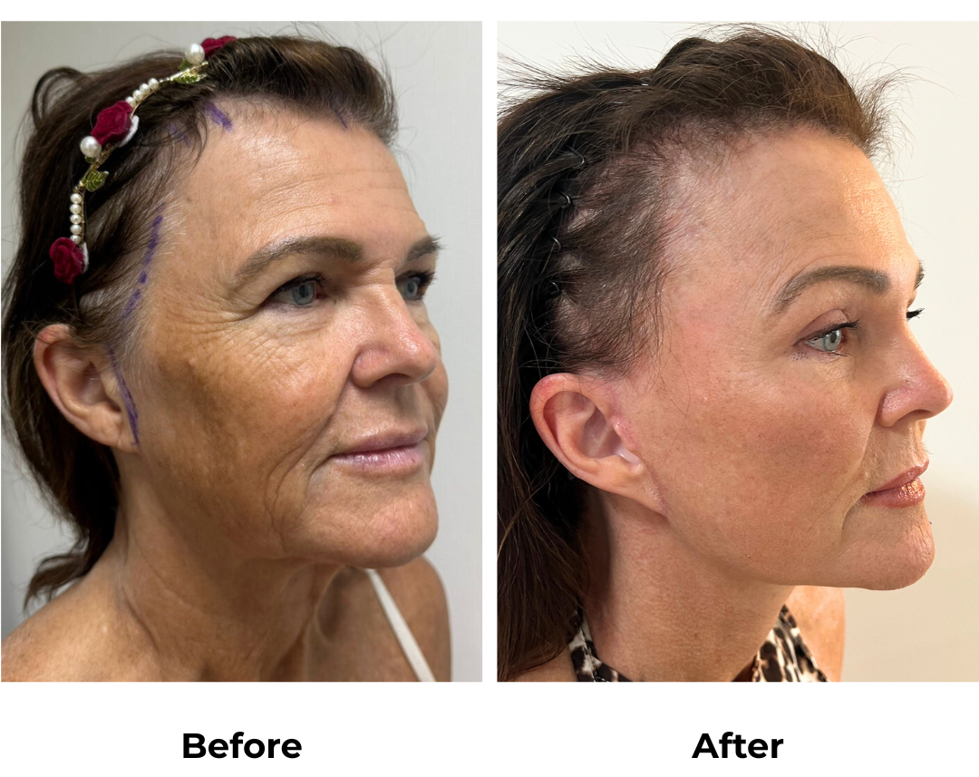 Maree FFNL + Endoscopic Brow Lift + Fat transfer to face with Dr. Ring (2)