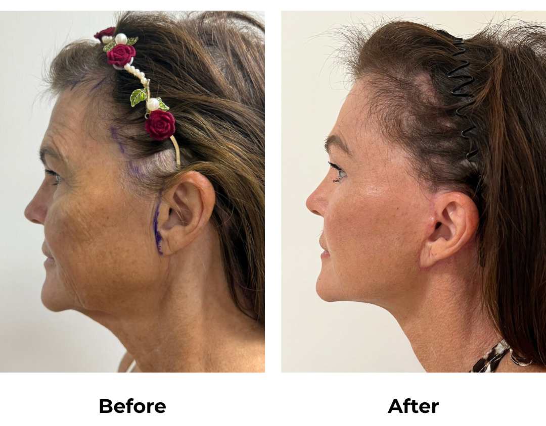 Maree FFNL + Endoscopic Brow Lift + Fat transfer to face with Dr. Ring (3)