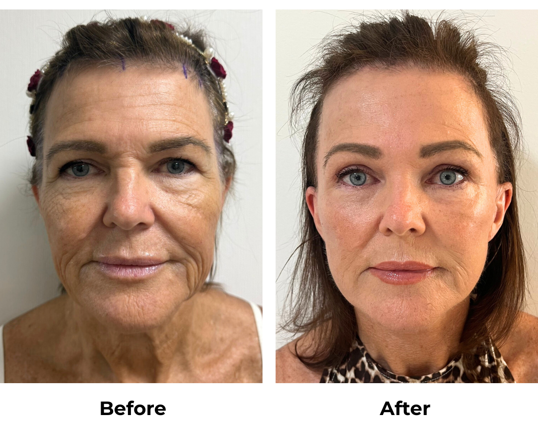 Maree FFNL + Endoscopic Brow Lift + Fat transfer to face with Dr. Ring-1