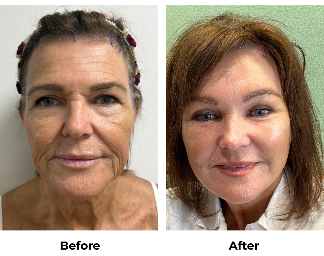 Maree FFNL + Endoscopic Brow Lift + Fat transfer to face with Dr. Ring
