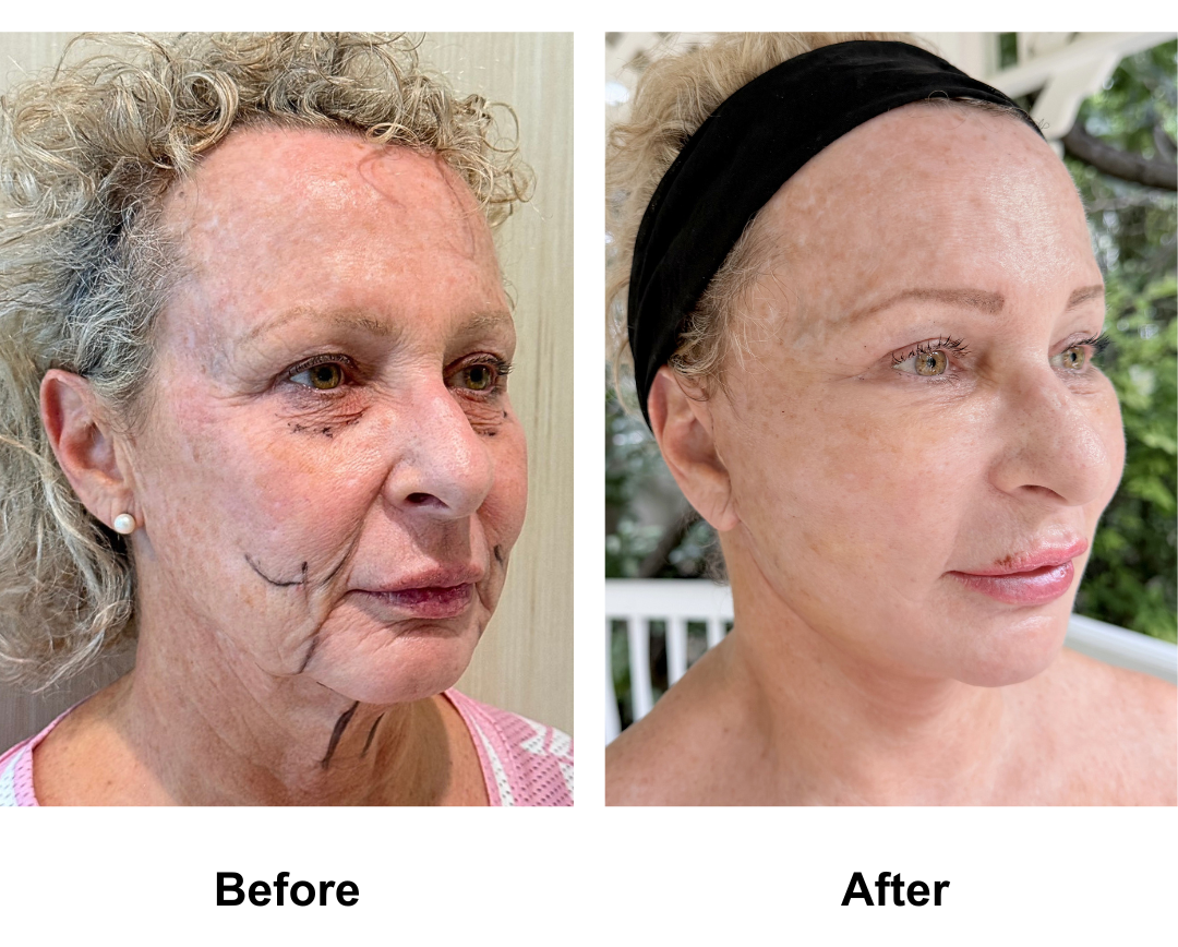 Maria, 57 had FFNL + Fat Transfer to Face with Dr. Jatuporn (2)