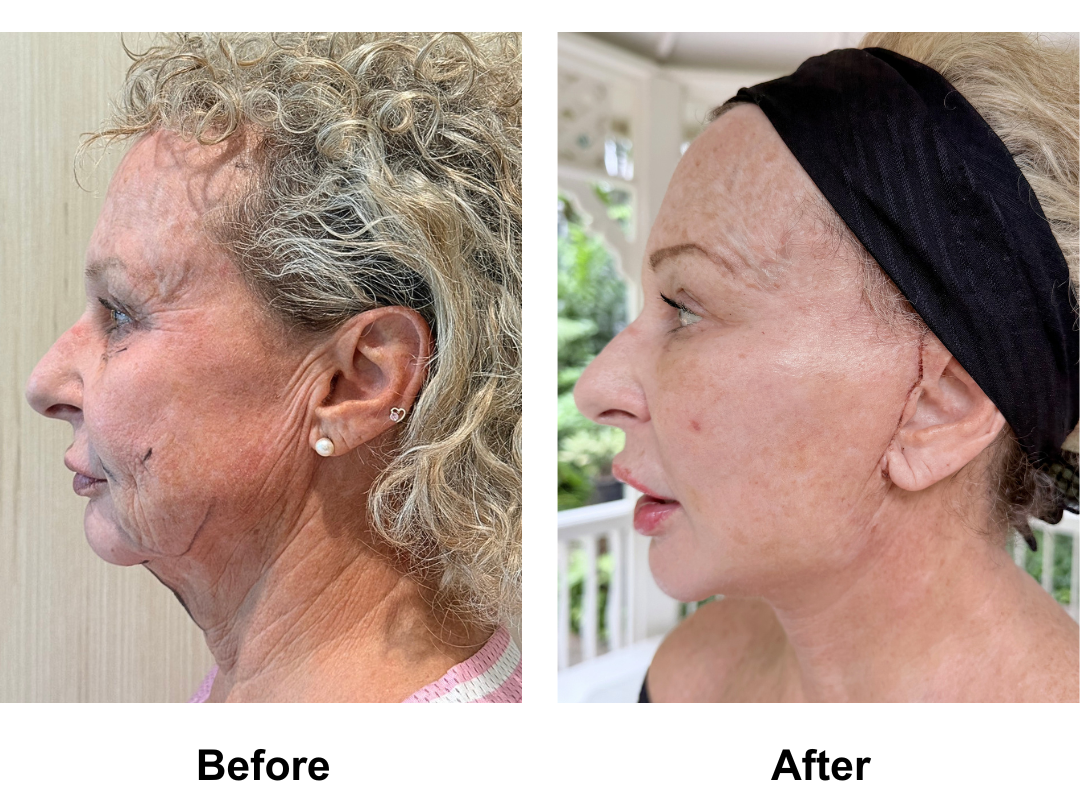 Maria, 57 had FFNL + Fat Transfer to Face with Dr. Jatuporn (3)