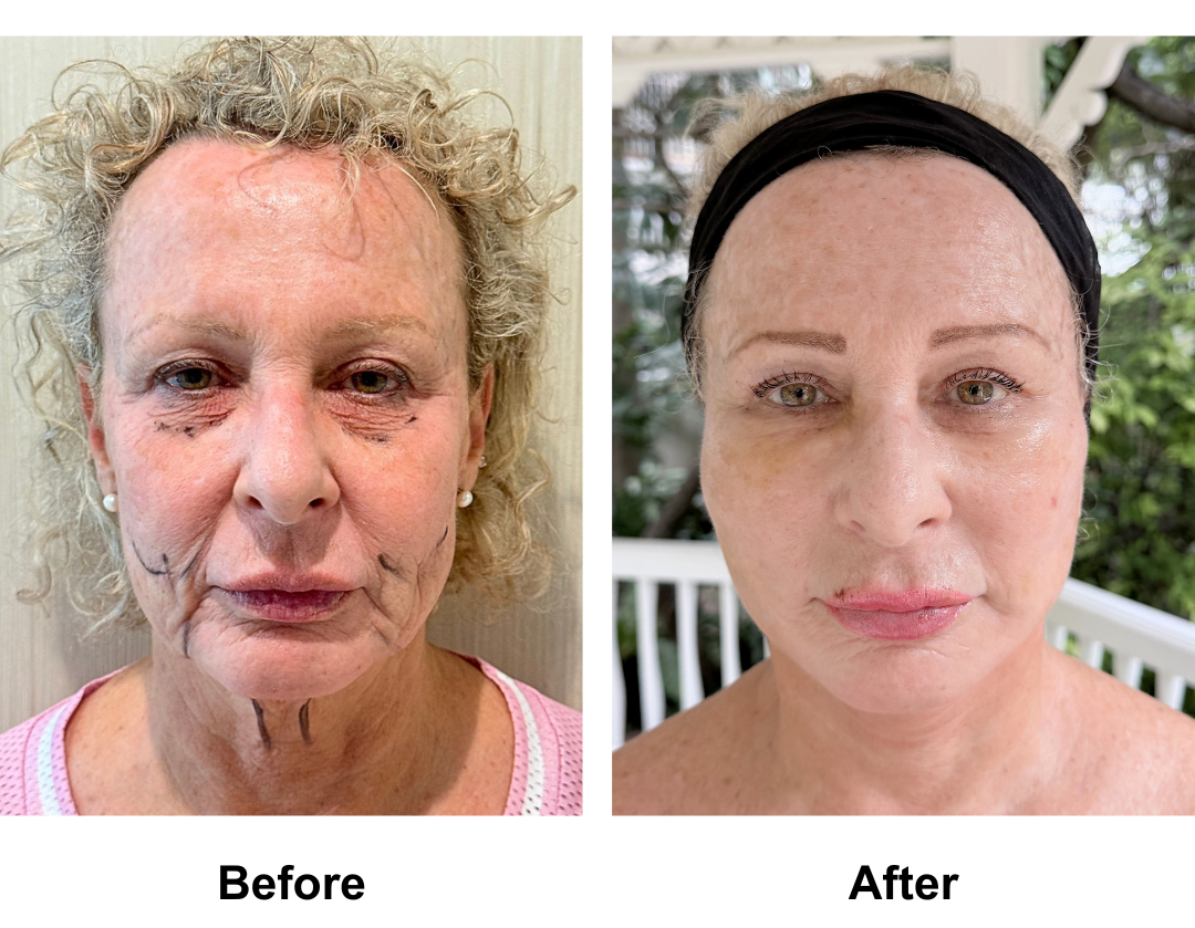 Maria, 57 had FFNL + Fat Transfer to Face with Dr. Jatuporn